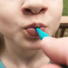 ARK proButton Set for Lip Closure - Image 2